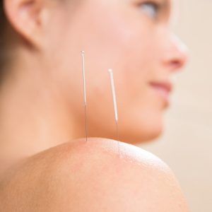 acupuntura