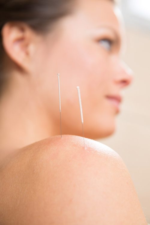 acupuntura